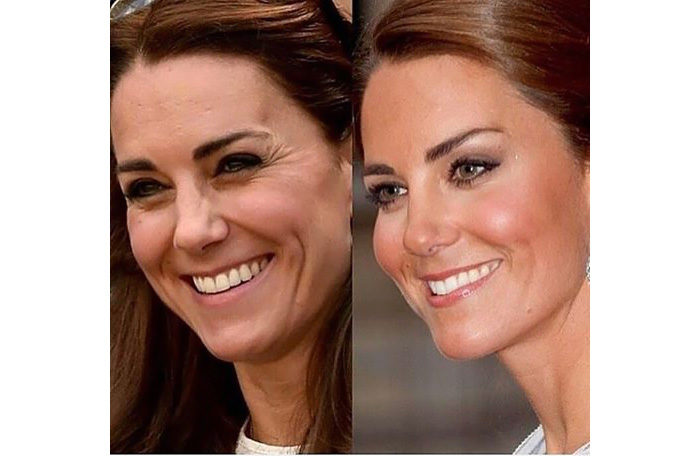 Tudo sobre meu botox: antes e depois, onde apliquei, etcEu vou de Rosa